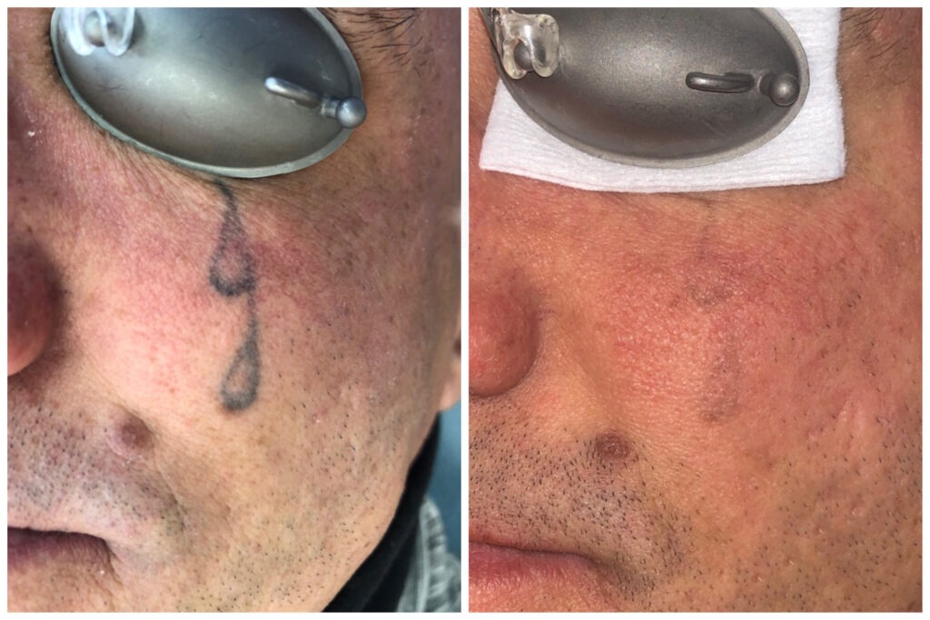 picosecond laser