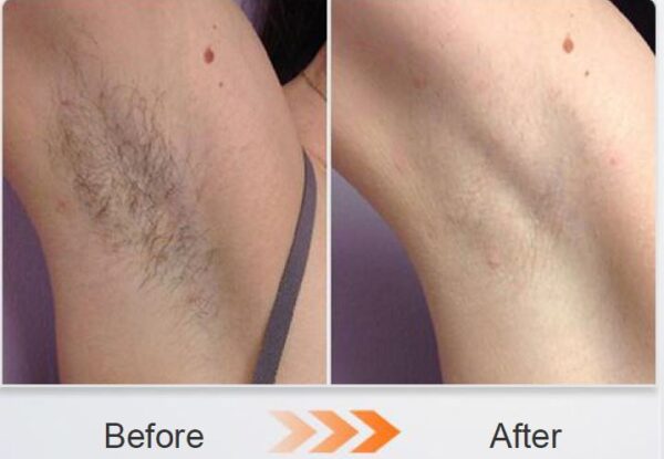 1800W-3000w - Hair Removal Diode Laser - Image 2