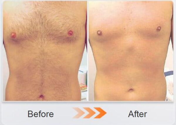1800W-3000w - Hair Removal Diode Laser - Image 3