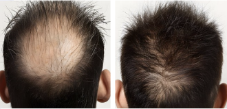 1565nm Non-Ablative Fractional Laser for Hair Growth - Image 3