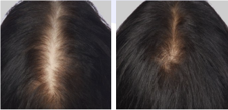 hair loss laser