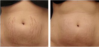 Thulium Laser - Image 2